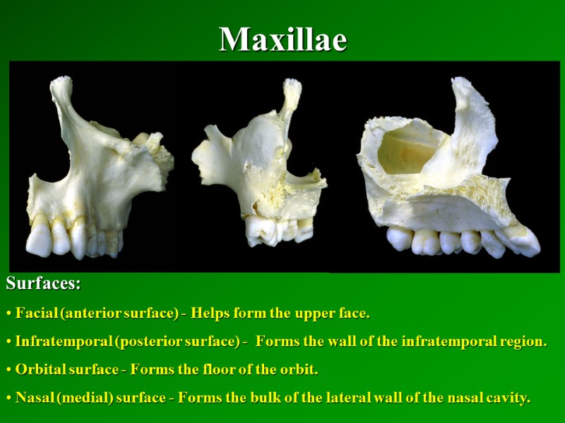 Maxillae   Surfaces:  Facial (anterior surface) - Helps form the upper face.